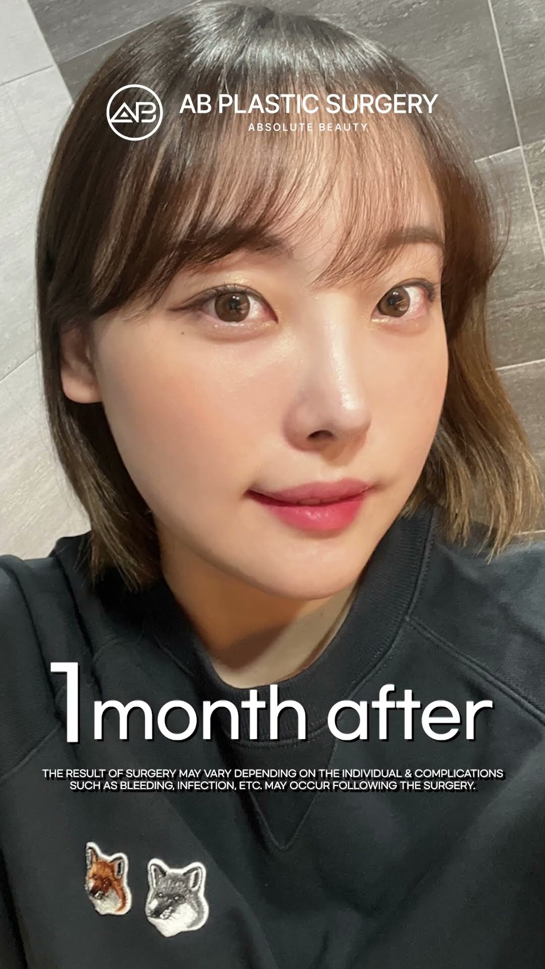 [Plastic surgery in Korea] Mandible Jaw + Revision Rhinoplasty #abplasticsurgery