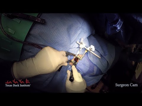 Cervical Artificial Disc Replacement Performed by Dr. Scott Blumenthal