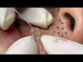 TREATMENT OF BIG BLACKHEADS AND HIDDEN ACNE IN THE MOUTH