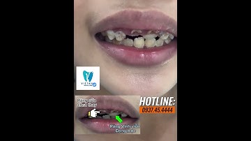Răng sữa chưa thay răng Vĩnh viễn đã mọc - ghé Việt Nha nhổ ngay