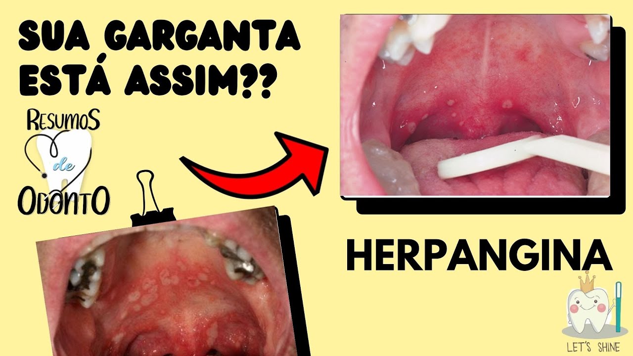 Herpangina: o que é, sintomas e tratamento - Tua Saúde