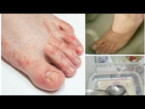 Video: Ayakkabıların Mantardan Tedavisi: Mantar Hastalıkları Için Nasıl Ve Nasıl Dezenfekte Edilir + Fotoğraflar Ve Videolar
