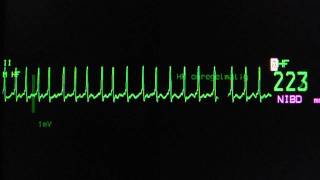 atrial fibrillation with rapid ventricular rate on an ECG heart monitor