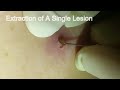 Extraction of a single lesion