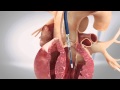 TAVI transfemoral - Transcatheter Aortic Heart Valve - 3D Animation Medizin