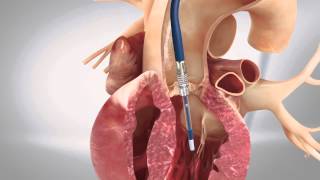 TAVI transfemoral - Transcatheter Aortic Heart Valve - 3D Animation Medizin screenshot 2