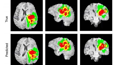 3D Brain tumor segmentation and classifications Tensorflow | Unet | LinkNet | +917973494585 whatsapp