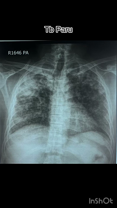 Kasus TB Paru//kasus 3 #xray #radiology #röntgen  #tbc #paruparu