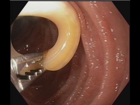 Ascariasis Removal from papilla #BD_ENDOSCOPY