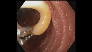 Ascariasis Removal from papilla #BD_ENDOSCOPY