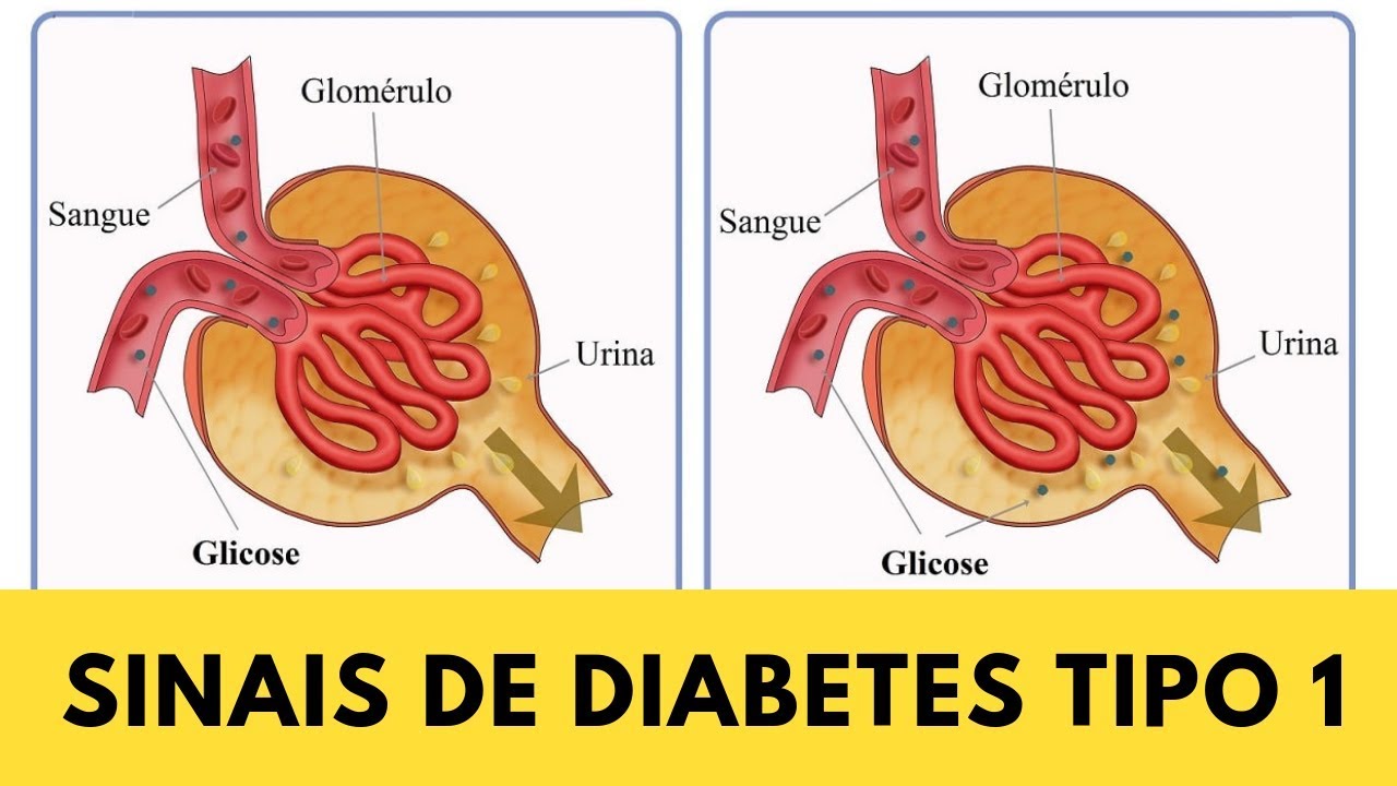 Sintomas de glucosa alta