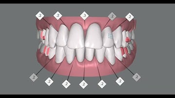 Alignment and intrusion of anterior teeth of an adult patient. invisalign clincheck simulation.