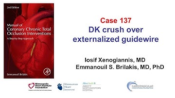 Case 137: Manual of CTO PCI - DK crush over externalized guidewire