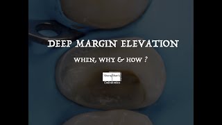 Garrison Reel Matrix vs Modified Tofflemire Matrix for Deep Margin