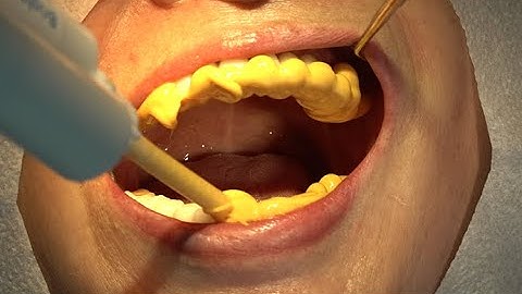 BTS Concepting (Bite Tray impression Scan)