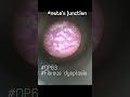 # Oral pathology slides # BDS 3 year