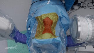 Cervical Foraminotomy