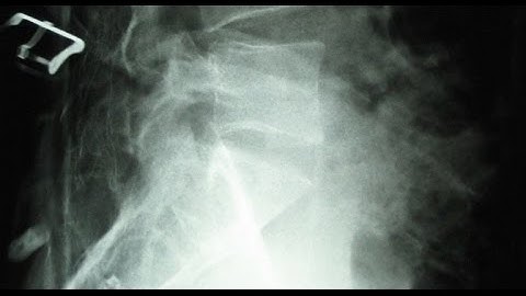 Video Explanation: What are Vertebral Compression Fractures?