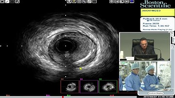 [TCTAP 2017] Coronary Symposium - Live Case Session VI