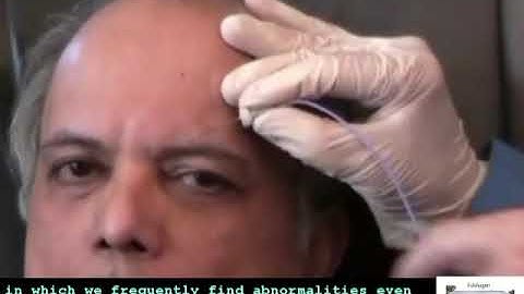 SFEMG - Volitional Frontalis  (Don Sanders)