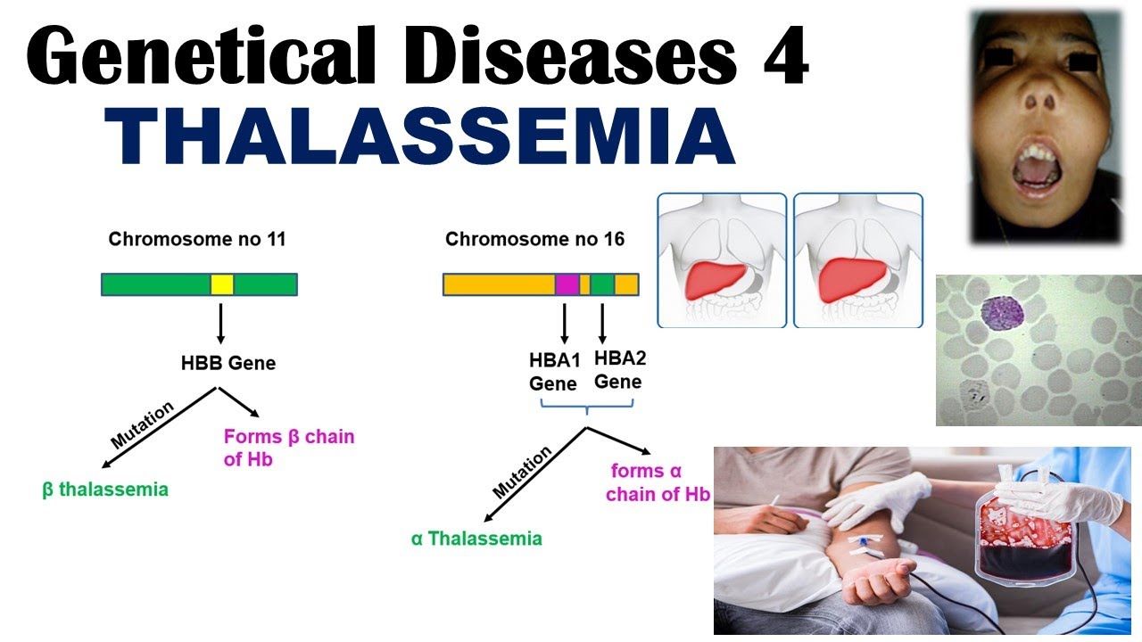 thalassemia anaemia)