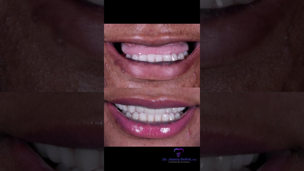 All on 4 Dental Implants in Dominican Republic YouTube