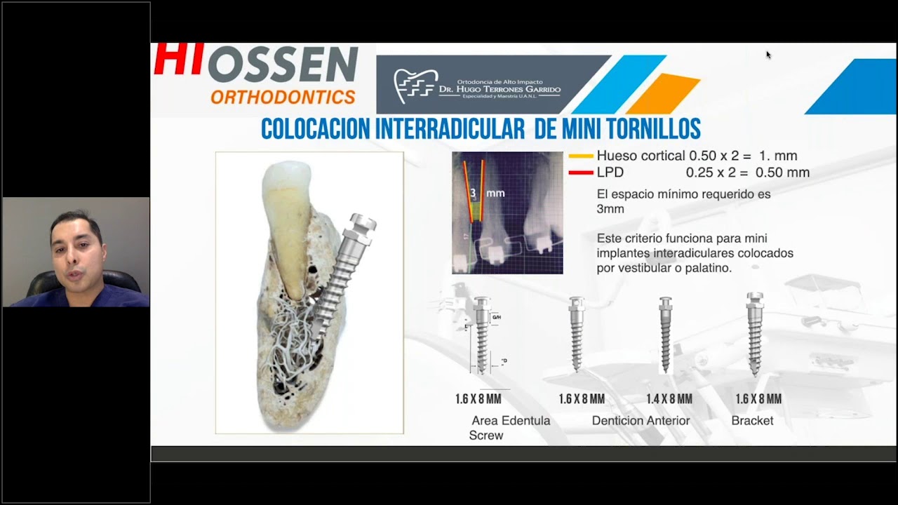 Webinar Criterios básicos al utilizar miniimplantes en ortodoncia impartida por el Dr. Hugo Terrones