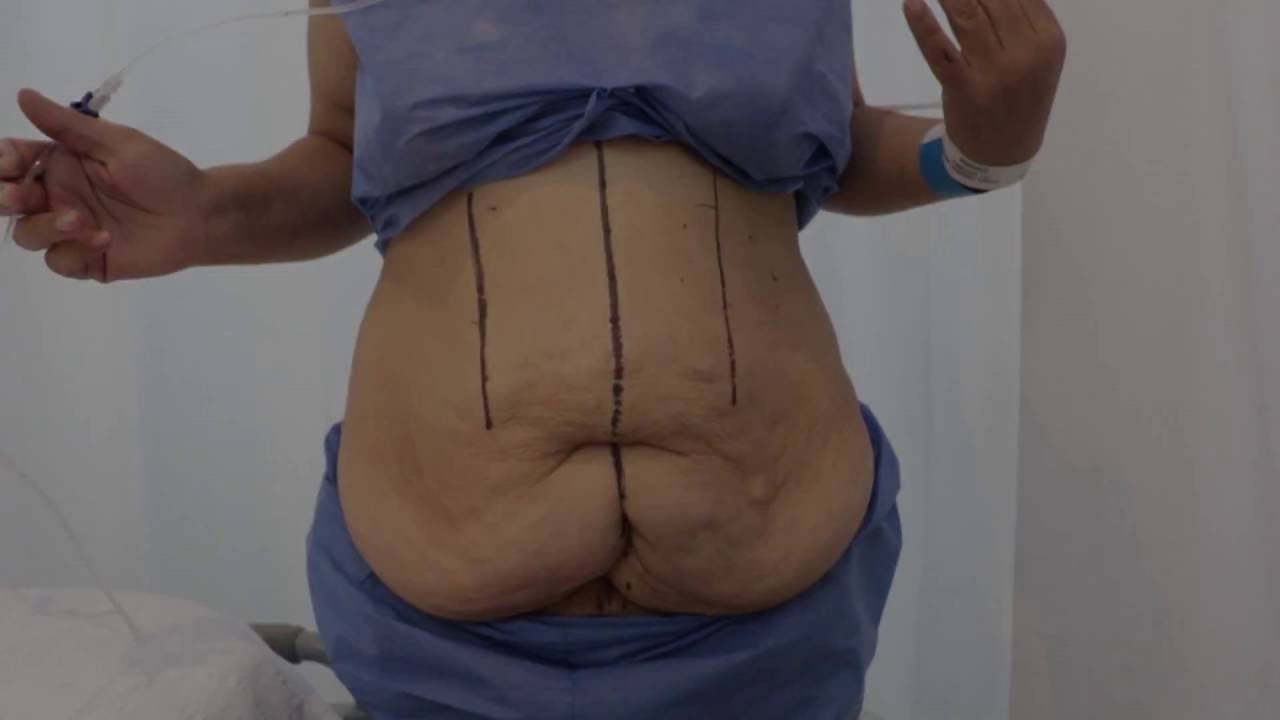 Uso de faja para piel sobrante - Parte 2 sexy pizza near me