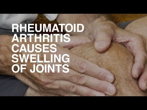 Rheumatoid Arthritis and Diet