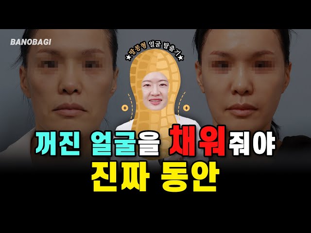 넙데데한 땅콩형 얼굴🥜볼 패임, 울퉁불퉁한 얼굴형 다 모여라🙆‍♂️🙆‍♀️얼굴형 관리 시술, 수술법 (필러, 지방이식)