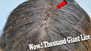 Giant Lice Extremely Damaged - Beautiful Long Hair Lice Combing