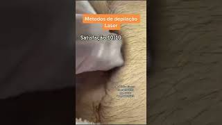 E Você Gosta Da Depilação A Laser???