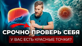 О Чем Говорят Красные Точки На Теле. Гемангиома - Опухоль Или Слезы Печени?