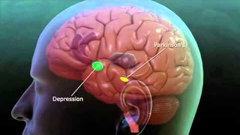 Deep Brain Stimulation explanation