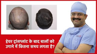 How Long It Takes For Hair To Grow After Hair Transplant | HairMD, Pune | (In HINDI)