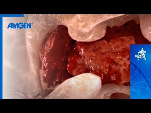 Video: Hvor bliver osteosarkommetastasering hen?