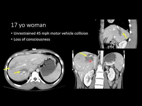 Blunt Abdominal Trauma Part 2   Liver Injury