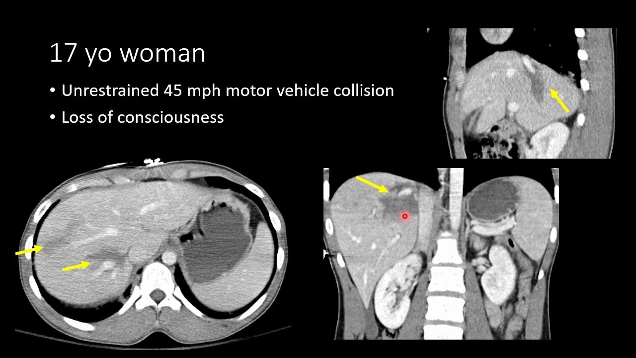 Тупая травма живота, часть 2. Повреждение печени