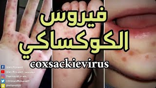 متلازمة اليد والقدم والفم ، فيروس الكوكساكي / coxsackievirus