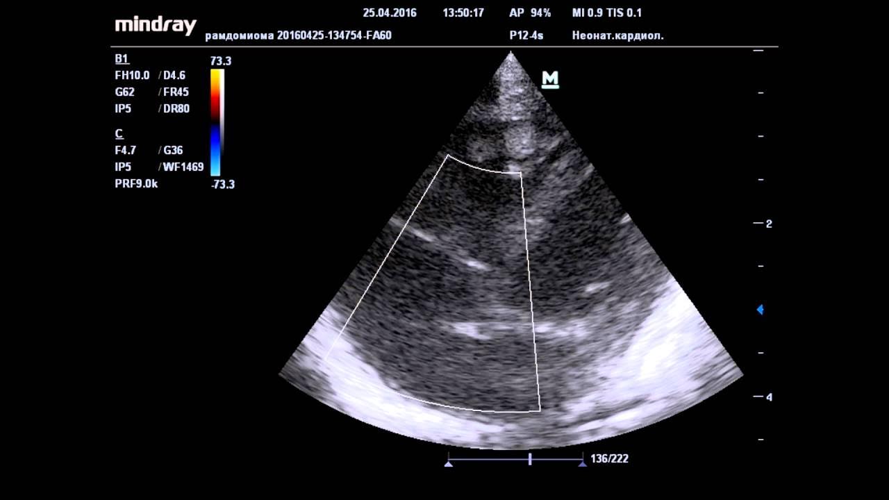 Рабдомиома сердца. Сердце плода УЗИ гидроперикард. Рабдомиома сердца левый желудочек. Рабдомиома сердца ЭХОКГ.