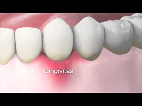 Periodonto ligos stadijos