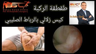 سبب مفاجئ لطقطقة الركبة.استئصال كيس زلالي من الرباط الصليبي