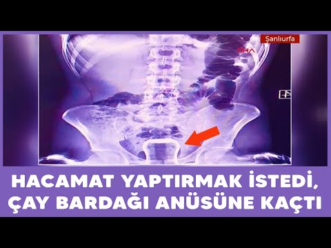 Hacamat yaptırmak istedi, anüsüne çay bardağı kaçtı