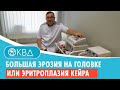 😲 Большая эрозия на головке или эритроплазия кейра. Клинический случай №751