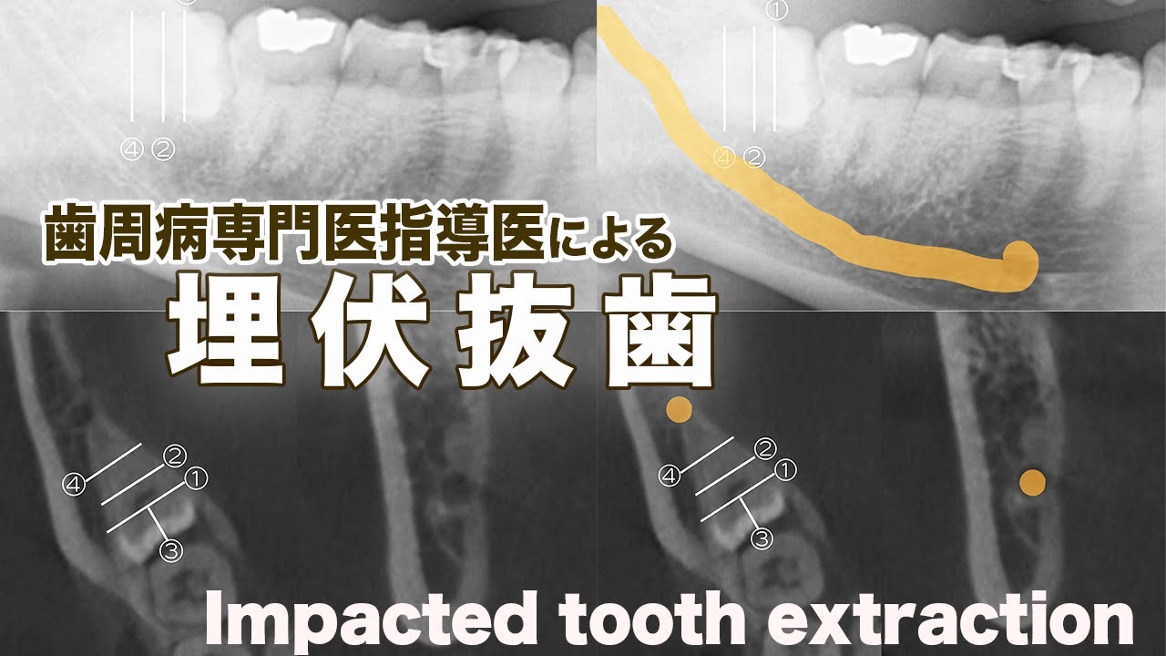 埋伏抜歯sop｜歯周病専門医による治療解説【Impacted tooth extraction