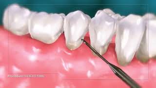 Professional Teeth Scaling & Gum Care Guide | Jain's Dental Villa