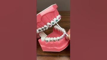 Hướng dẫn vệ sinh răng niềng bằng bản chải kẽ  #niengrang #orthodontist #niềngrăng #dentist