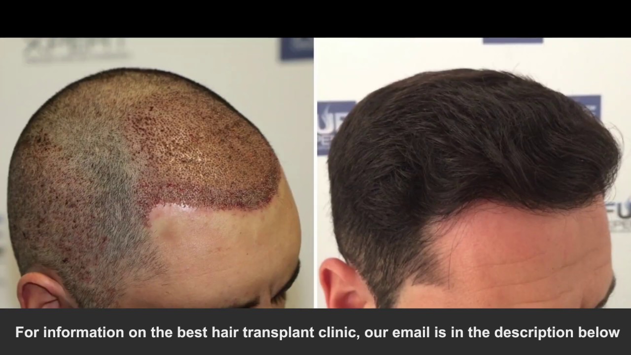 Best Hair Transplant Clinic 2020 You Never Knew Existed - YouTube