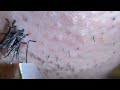 Plucking facial hair & ingrown hair 852 喉髭抜き(埋没毛あり)