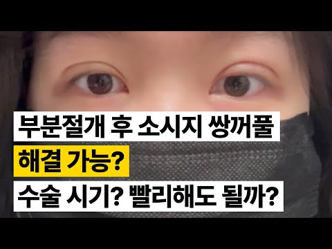 성형상담소 💌 I 부분절개 후 소시지 쌍꺼풀 해결 가능? 수술 시기? 빨리해도 될까?